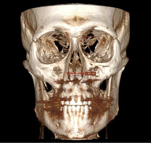Narrow_Nose_Apperture_small