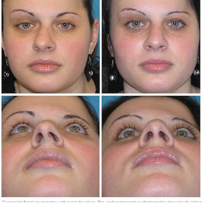 Nose_Asymmetry