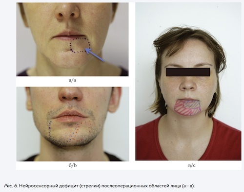 Surgery_Complications_02