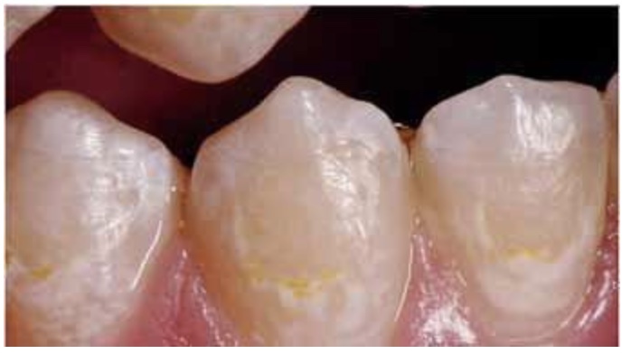 Enamel_Damage