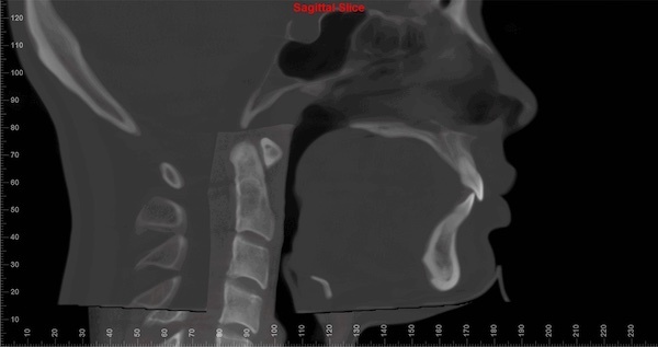 Premolar_extractions_Side_02